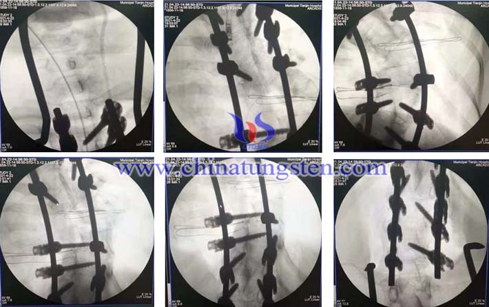 首套國産鈷鉻鉬脊柱內固定系統啓用圖片
